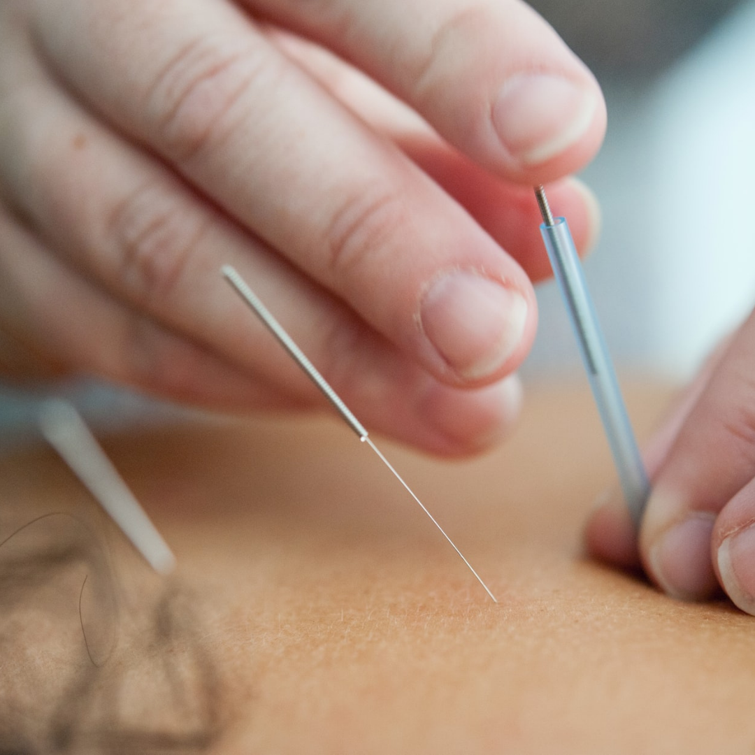 My Experience with Acupuncture for Nerve Pain